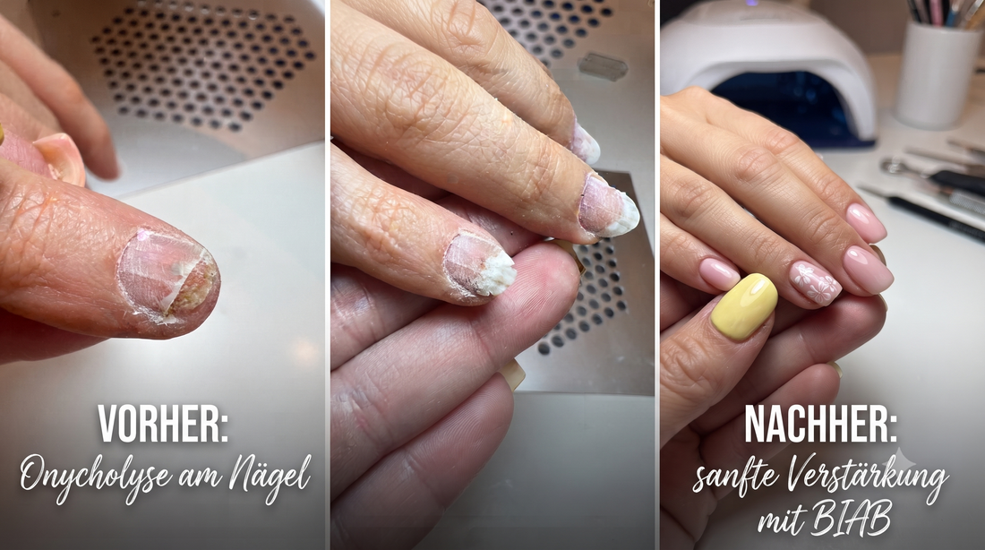 Onycholyse Nägel durch Nagelfolien?