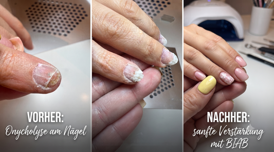 Onycholyse Nägel durch Nagelfolien?